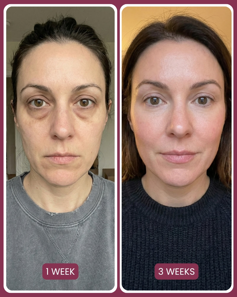 Target Neck Lines, Crepey Skin & Loss of Firmness.