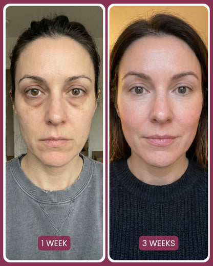 Target Neck Lines, Crepey Skin & Loss of Firmness.